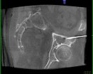 Siemens Healthcare Syngo Needle Guidance | Which Medical Device